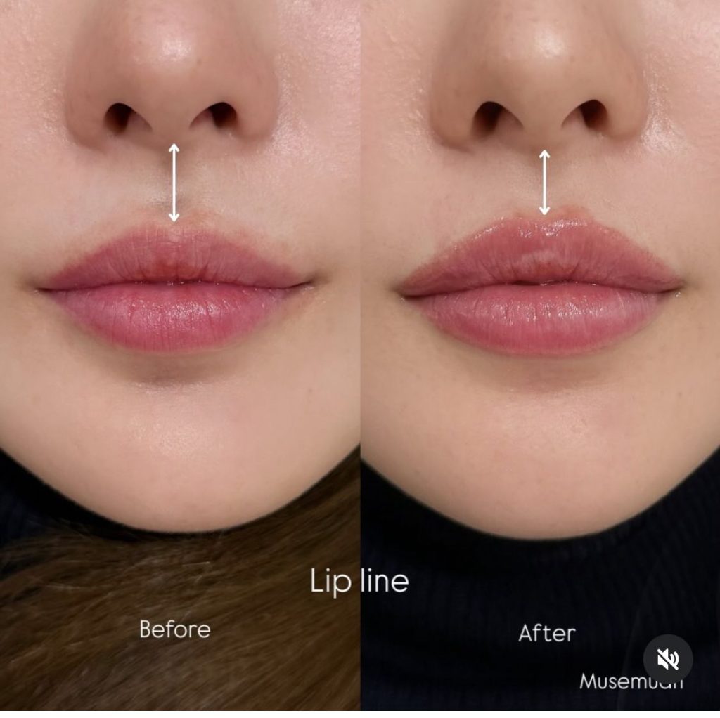 Upper Lip Liftلیفت لب