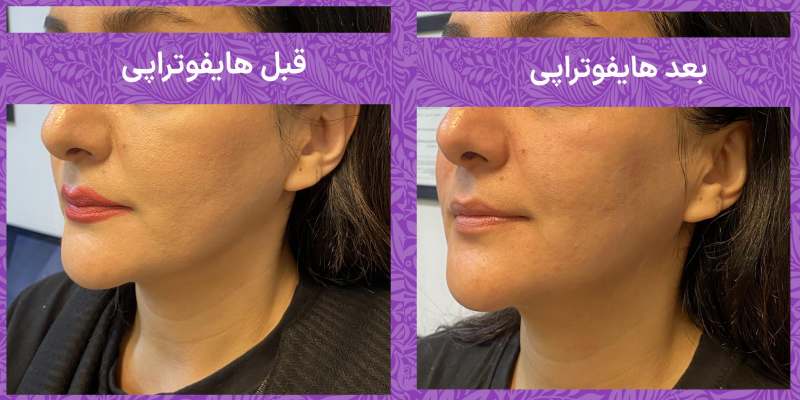تکنیکهای جوانسازی در کلینیک دسپینا
